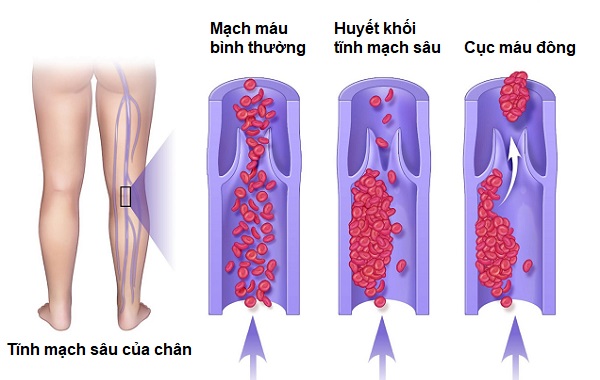 Thuyên tắc phổi: Triệu chứng, nguyên nhân và cách điều trị