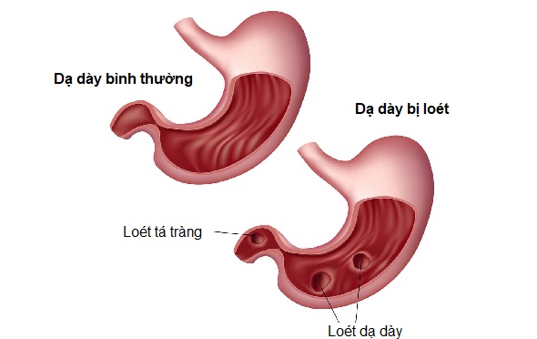 Loet-da-day-va-loet-ta-trang-nam-o-vi-tri-khac-nhau