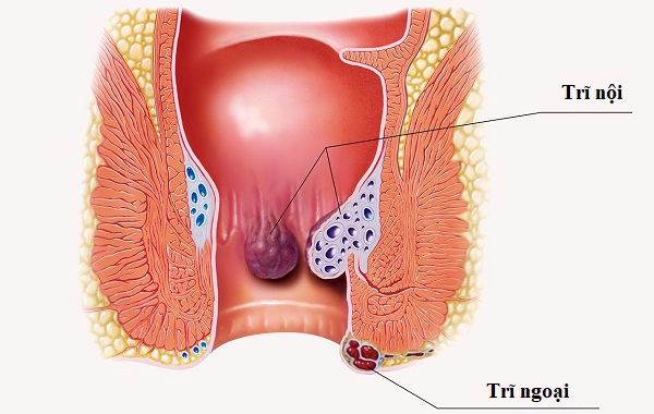 Tổng quan về bệnh trĩ | PK BV Đại học Y Dược 1